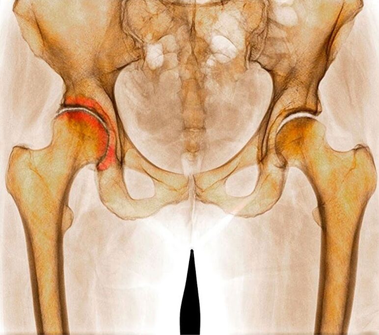 Hip-artikulazioaren artrosia