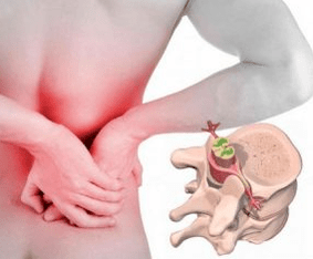 Lumbago gaixotasunaren osteokondrosiaren hasieran
