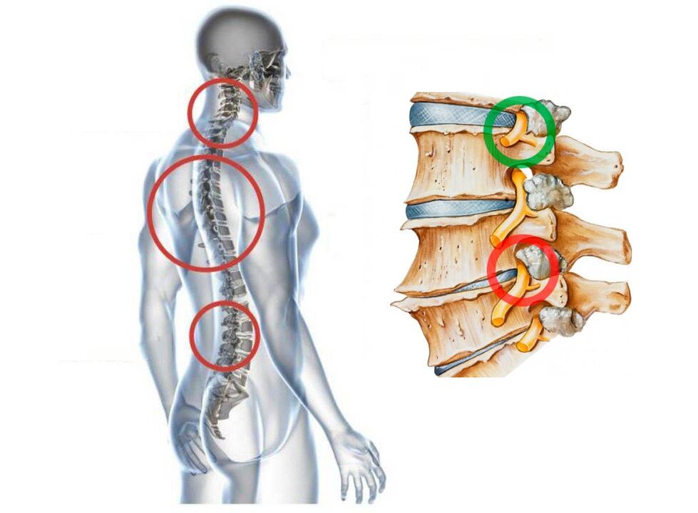 Nolakoa da ornodunen osteochondrosis cervikala