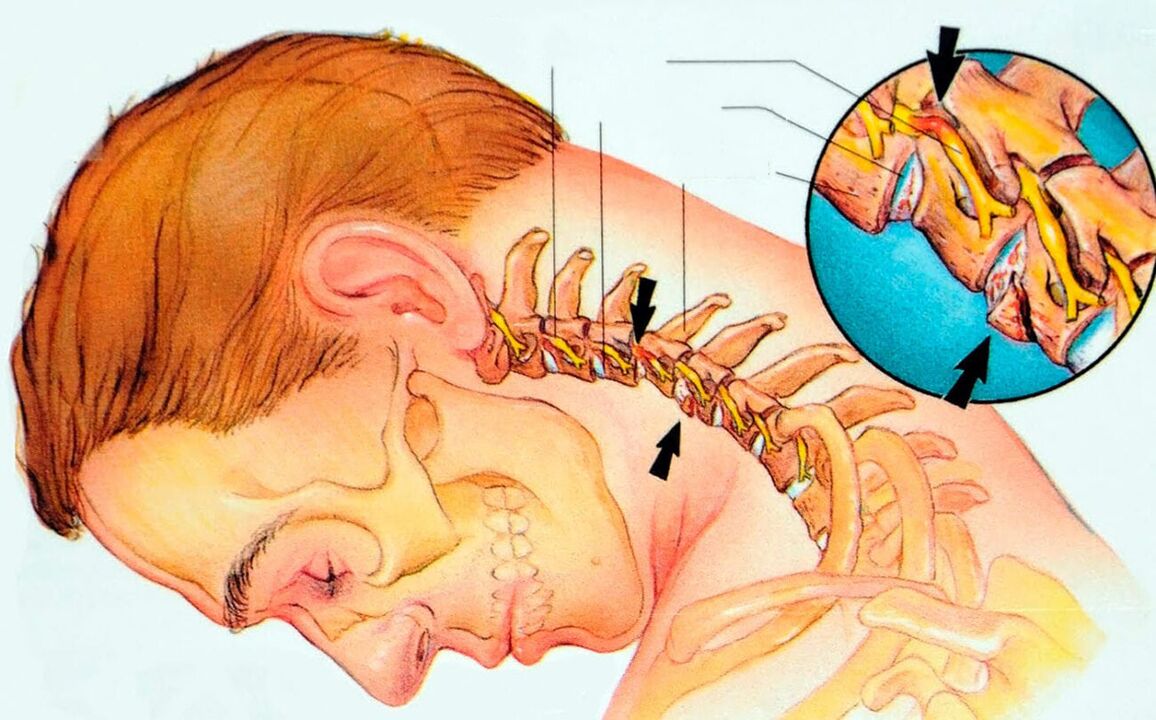 Zer da Cervical Osteokondrosia