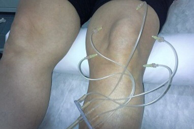 Ozono terapia