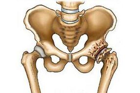 artrosian hip artikulazioa suntsitzea