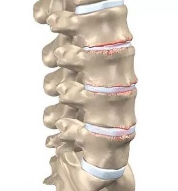 Osteokondrosia