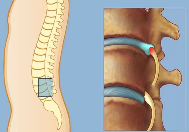 Rook sindrome